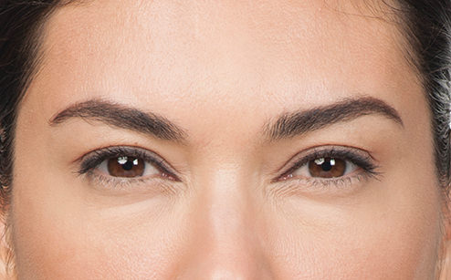 BOTOX® Before & After Gallery - Patient 597735 - Image 2