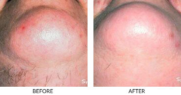 Laser hair removal penile shaft