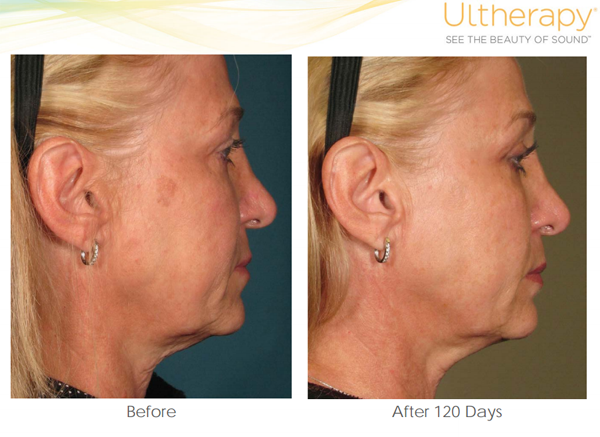 Before and After Ultherapy Photos