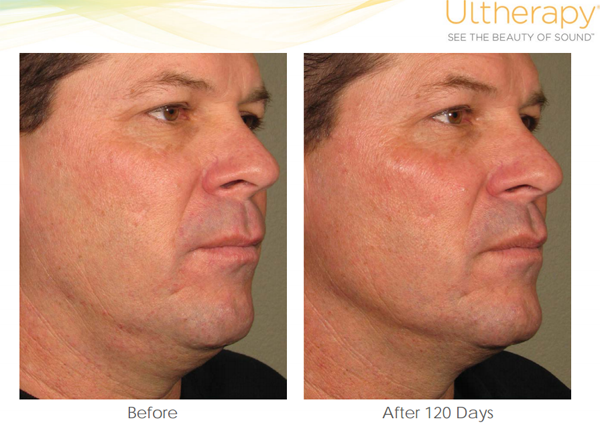 Before and After Ultherapy Photos