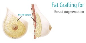 Fat Grafting and Breast Surgery