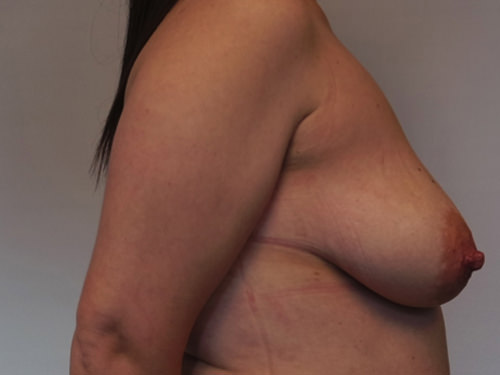 Breast Lift Before & After Case