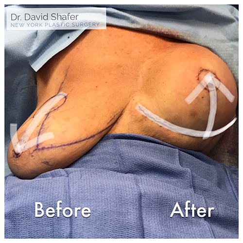 Breast Lift by Dr. Shafer