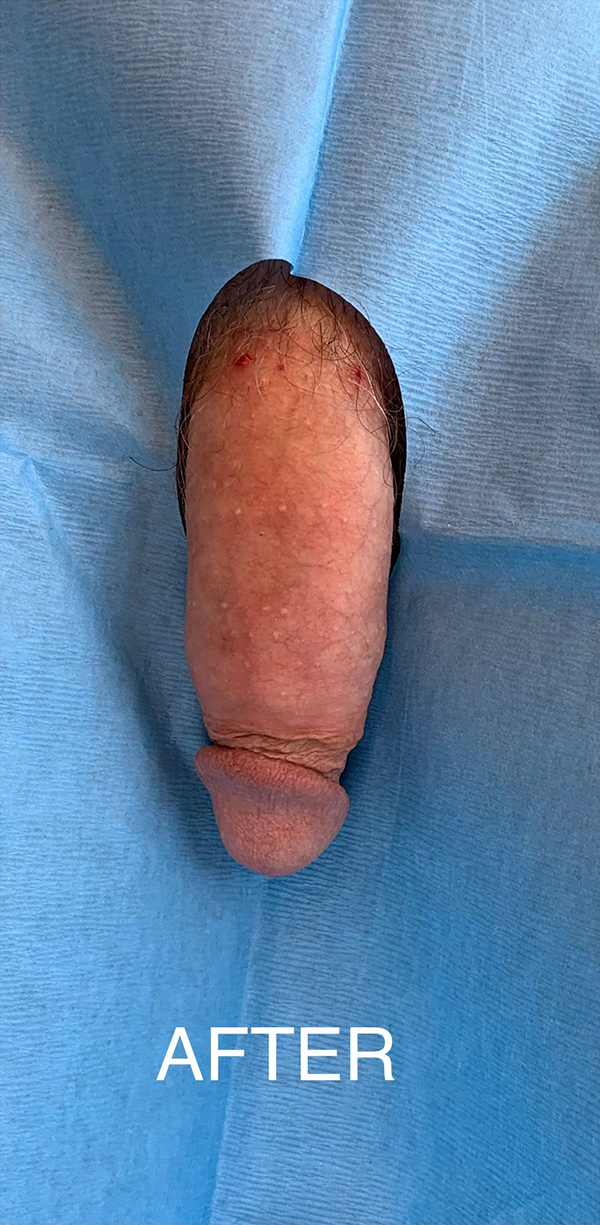 Vaginal Rejuvenation 