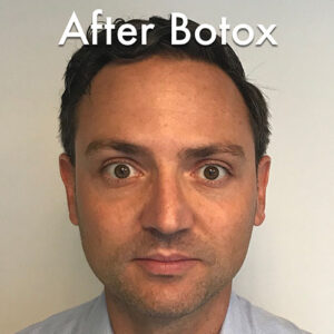 1729197262-botox-8460