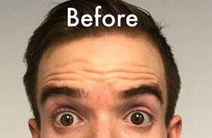 1729197322-botox-afb0