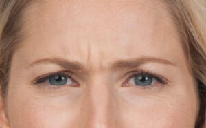 1729197385-botox-42b4