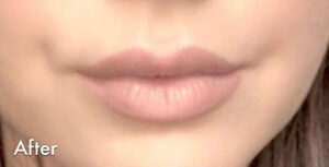 1729198025-juvederm-ecd4