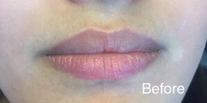 1729198043-juvederm-a9ca