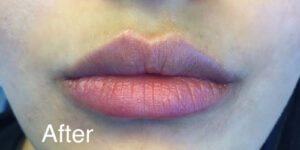 1729198049-juvederm-64c2