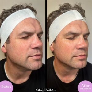 Glo2Facial B&A Refine with RF Pro